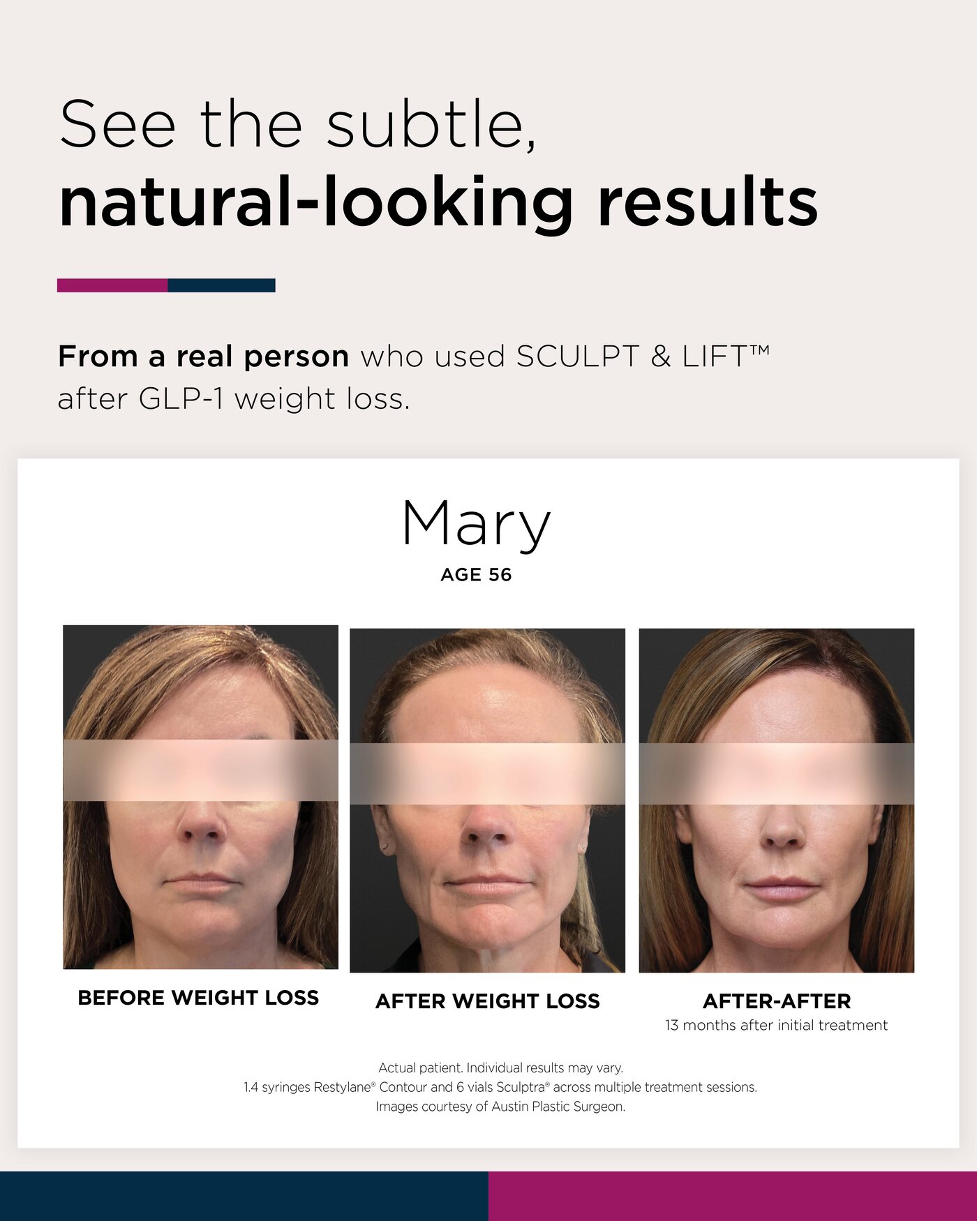 Mary Brown before weight loss, after weight loss, and after aesthetic treatment results
