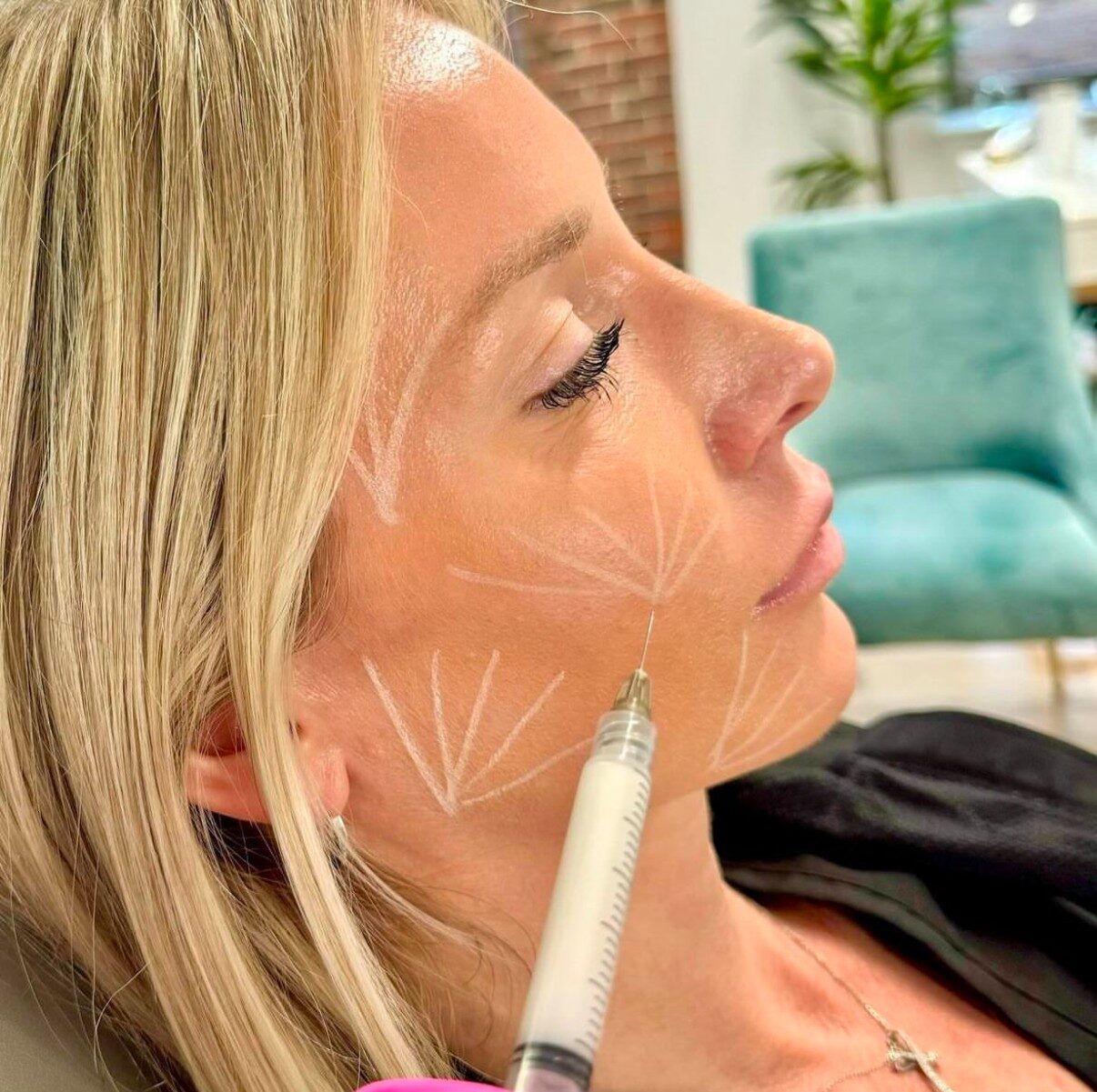 Sculptra treatment during a personalized aesthetic consultation