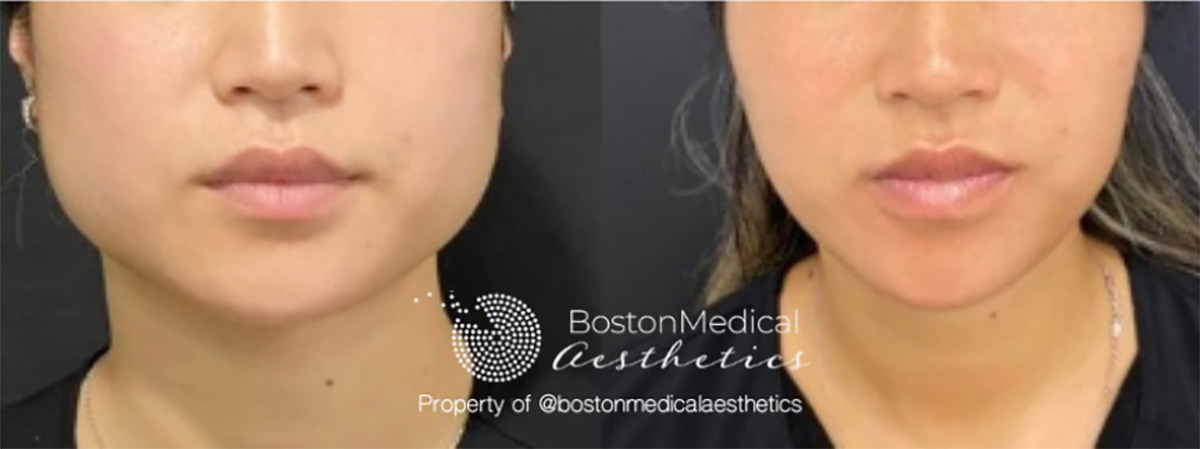 Botox for Jaw Slimming Boston