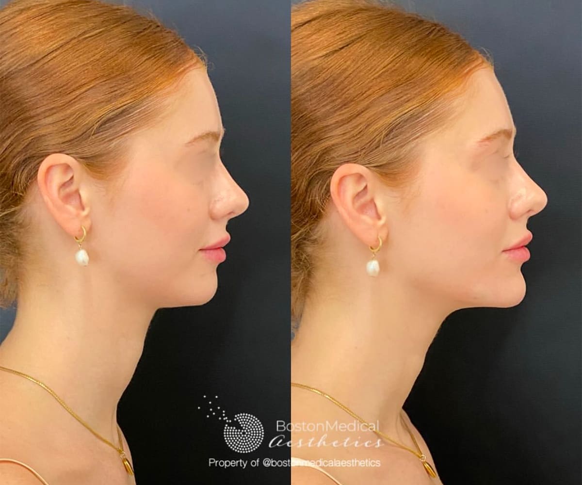 Chin Augmentation patient model in a hat smiling