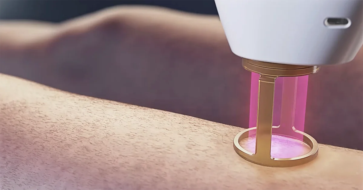 laser hair removal model wearing a bikini on the beach