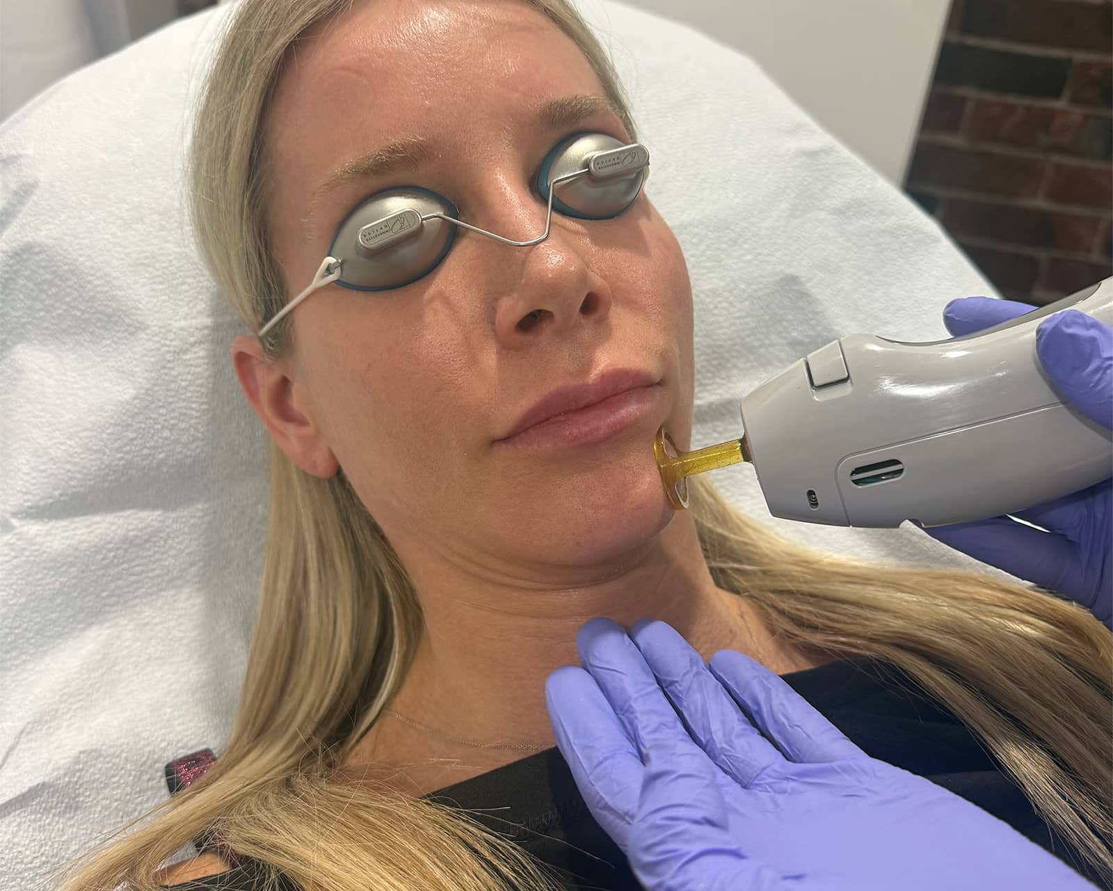 Laser Pigmentation Treatment Boston