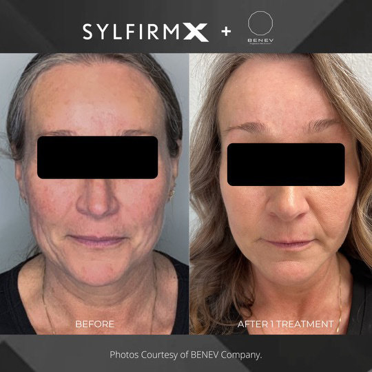 Sylfirm X patient before and after photos