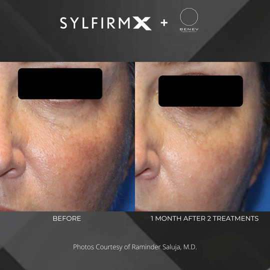 Sylfirm X patient before and after photos