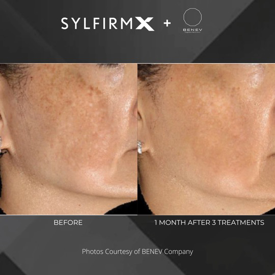 Sylfirm X patient before and after photos