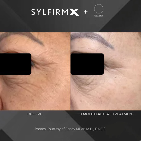 Sylfirm X patient before and after photos