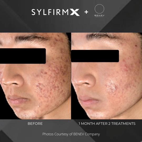 Sylfirm X patient before and after photos