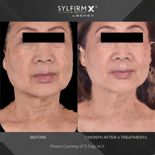Sylfirm X patient before and after photos