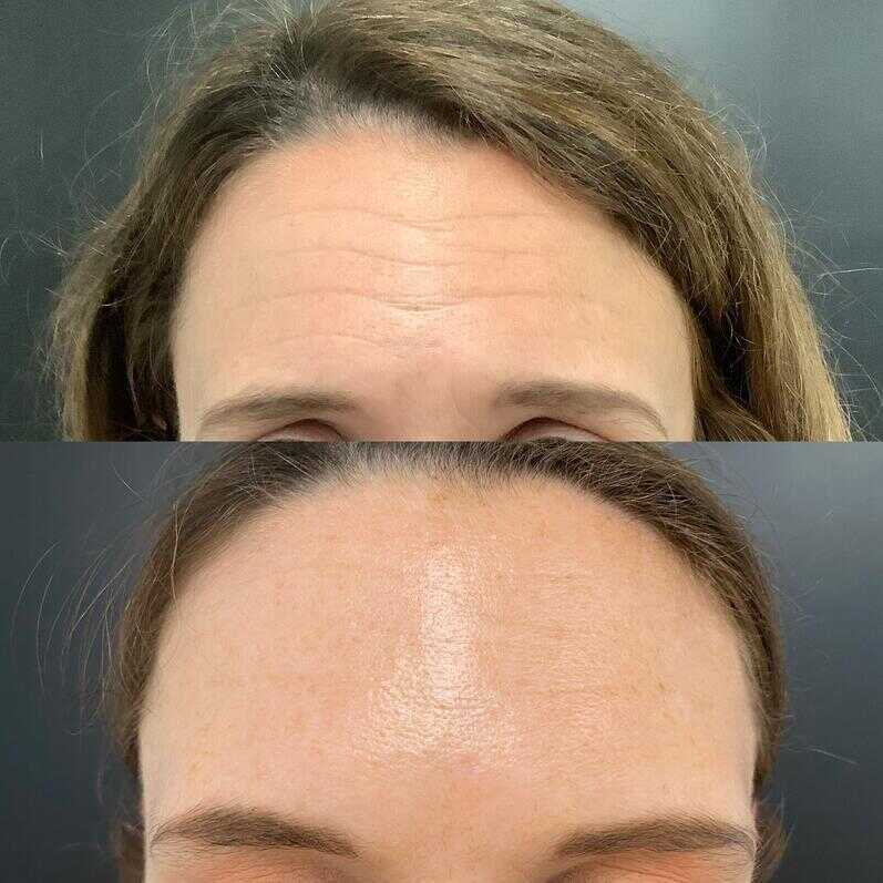 Botox Before & After Photo