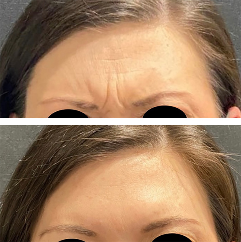 Botox Before & After Photo