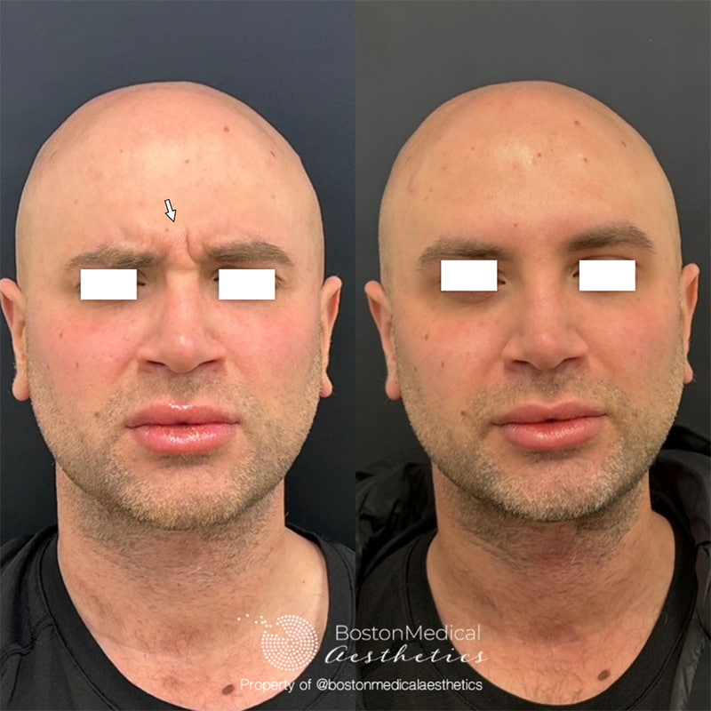 Botox and Dysport Before & After Photo