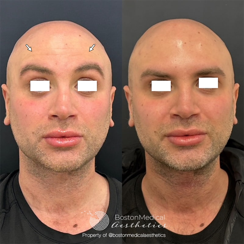 Botox and Dysport Before & After Photo