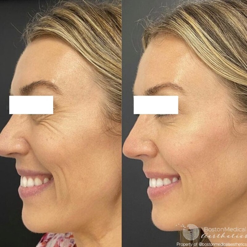 Botox Before & After Image