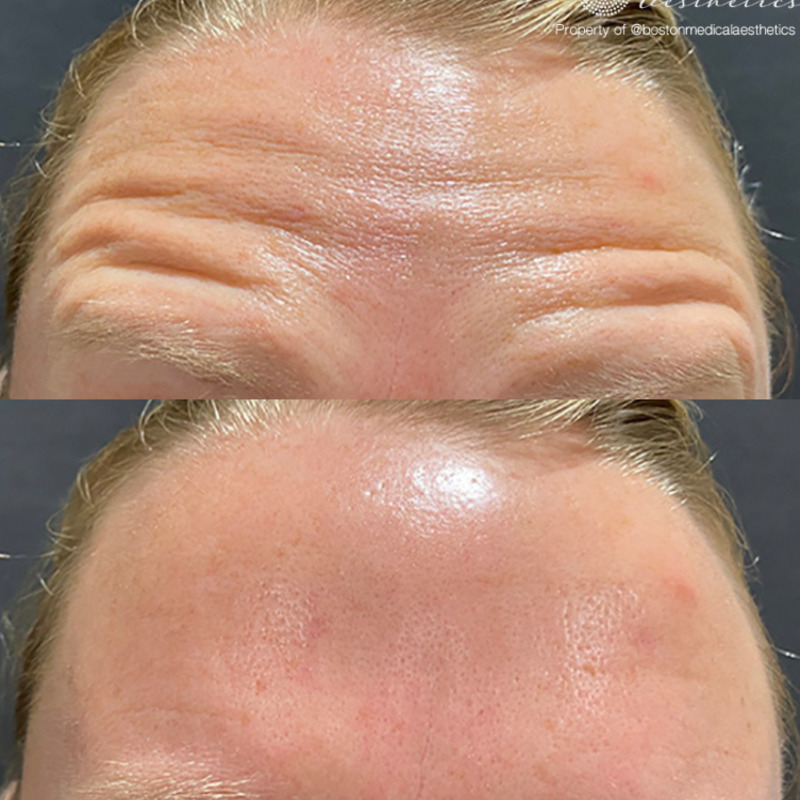 Botox Before & After Image