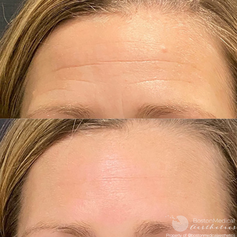 Botox Before & After Image