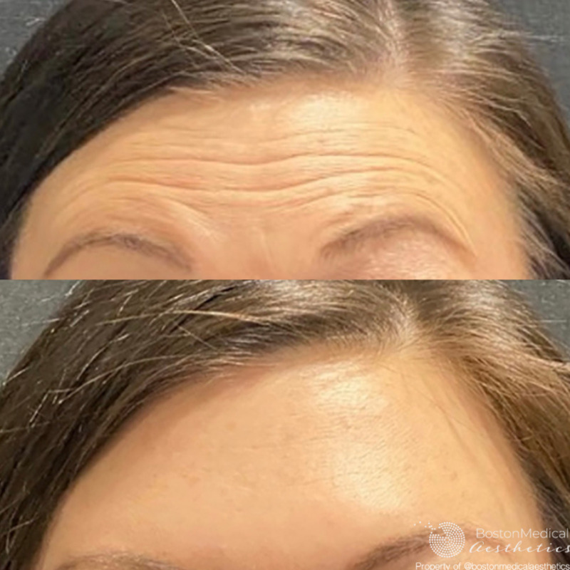 Botox Before & After Image