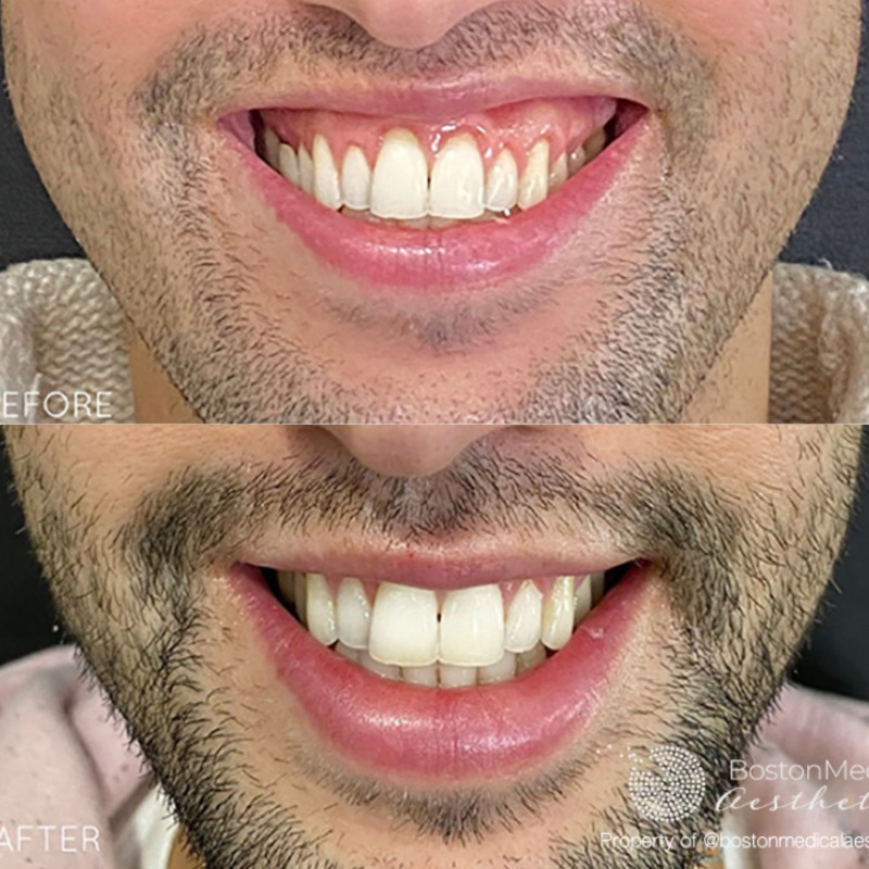 Botox Before & After Image