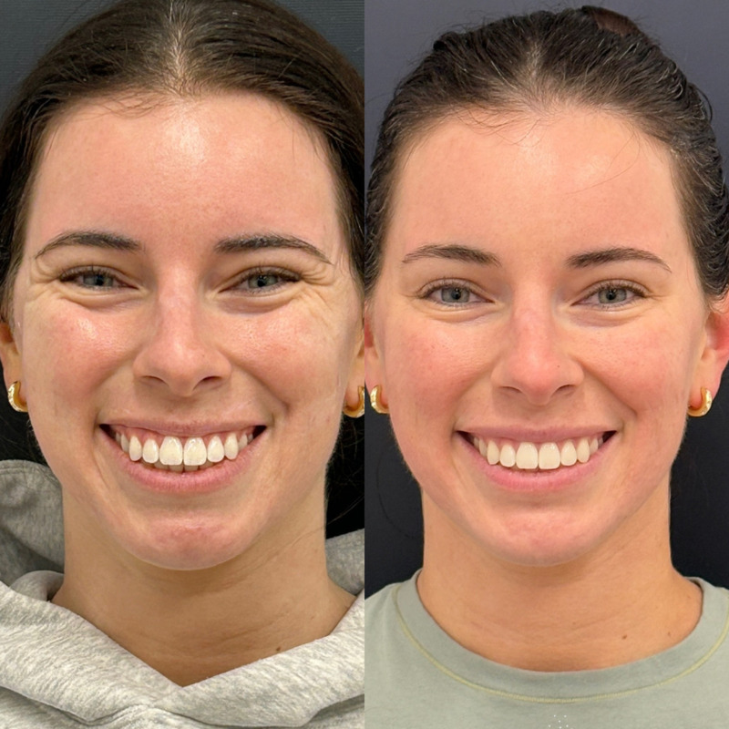 Botox and Dysport Before & After Photo