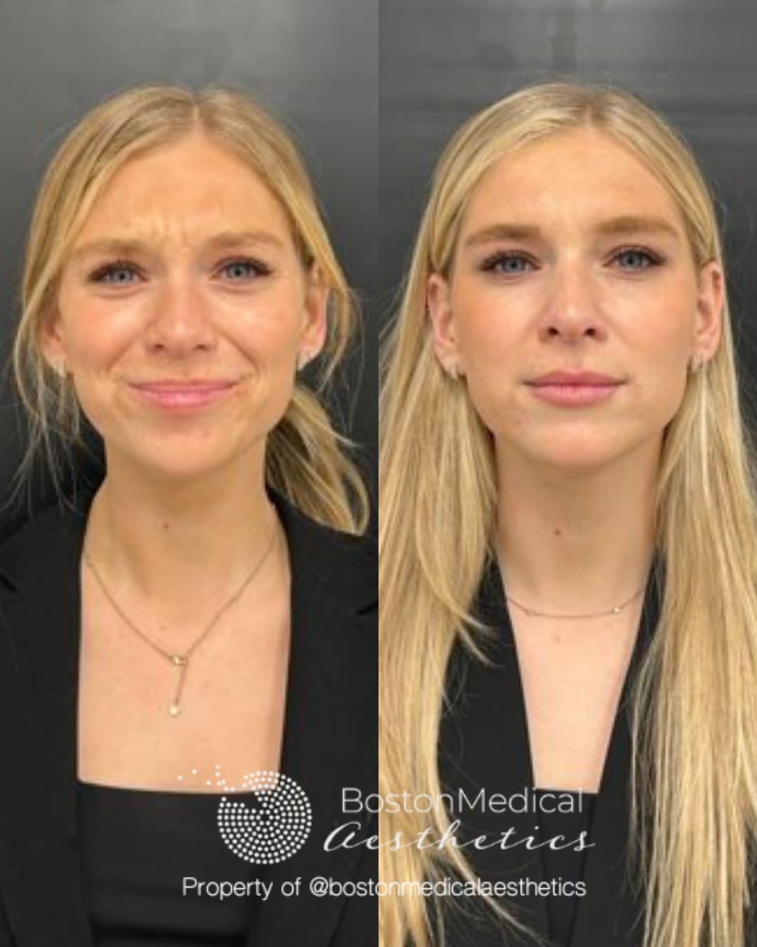 Botox and Dysport Before & After Photo