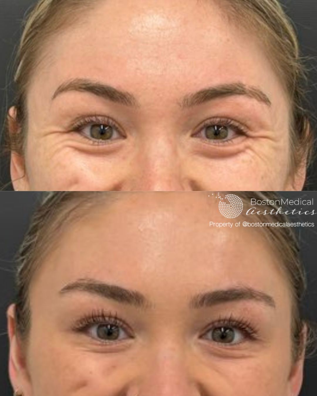 Botox and Dysport Before & After Photo
