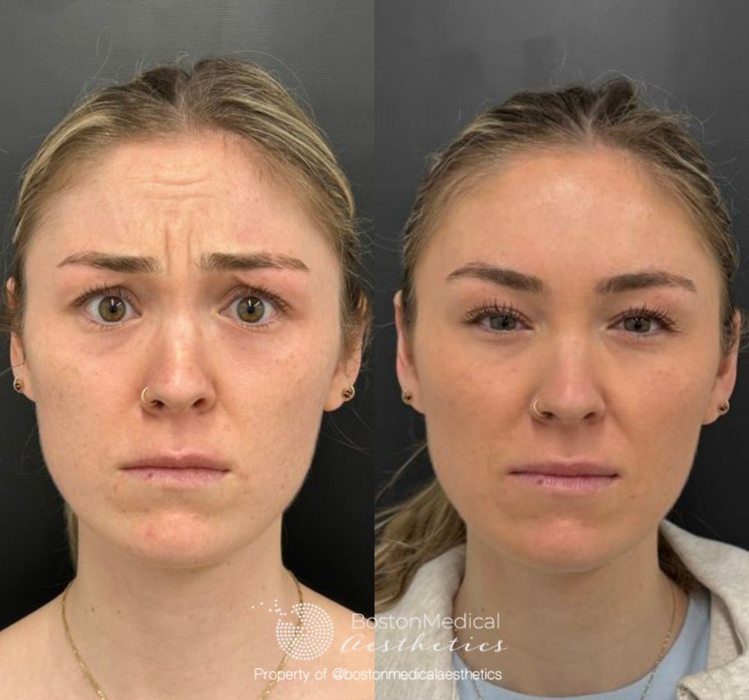 Botox and Dysport Before & After Photo