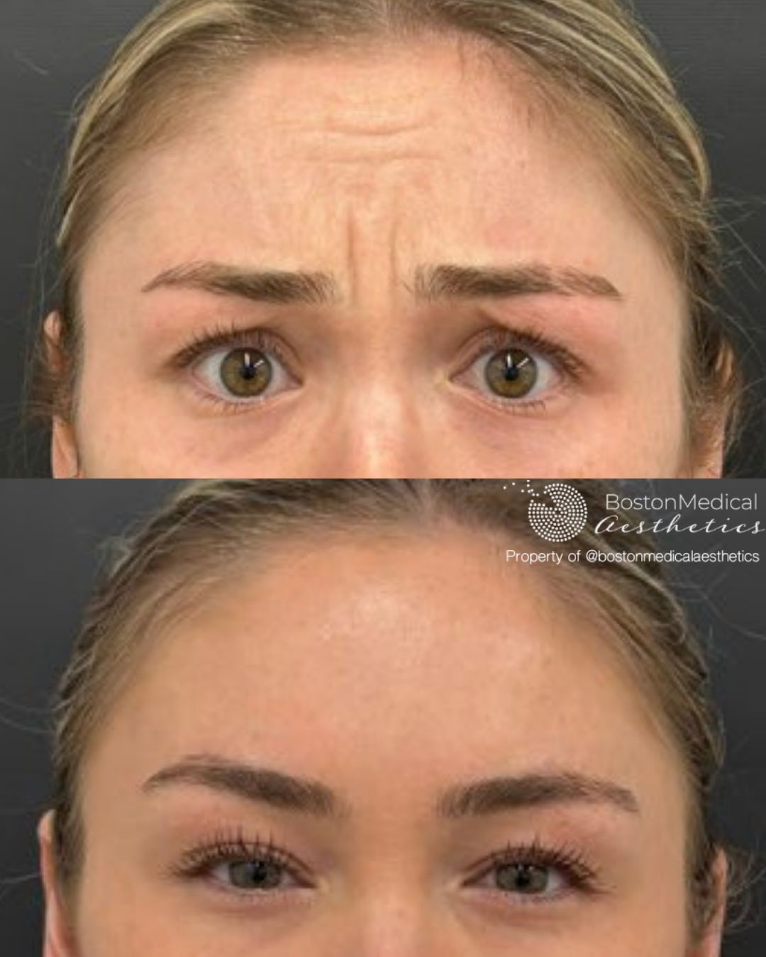 Botox and Dysport Before & After Photo