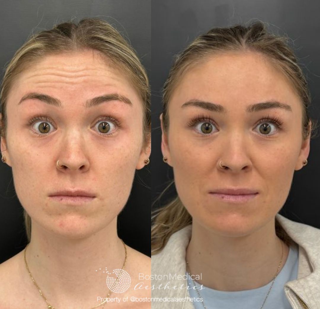 Botox and Dysport Before & After Photo