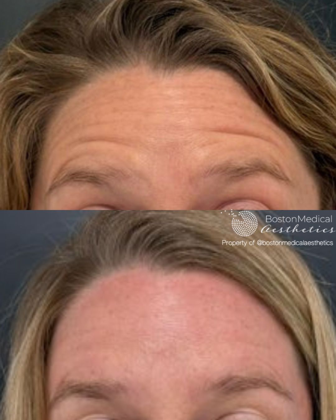 Botox & Dysport Before & After Image