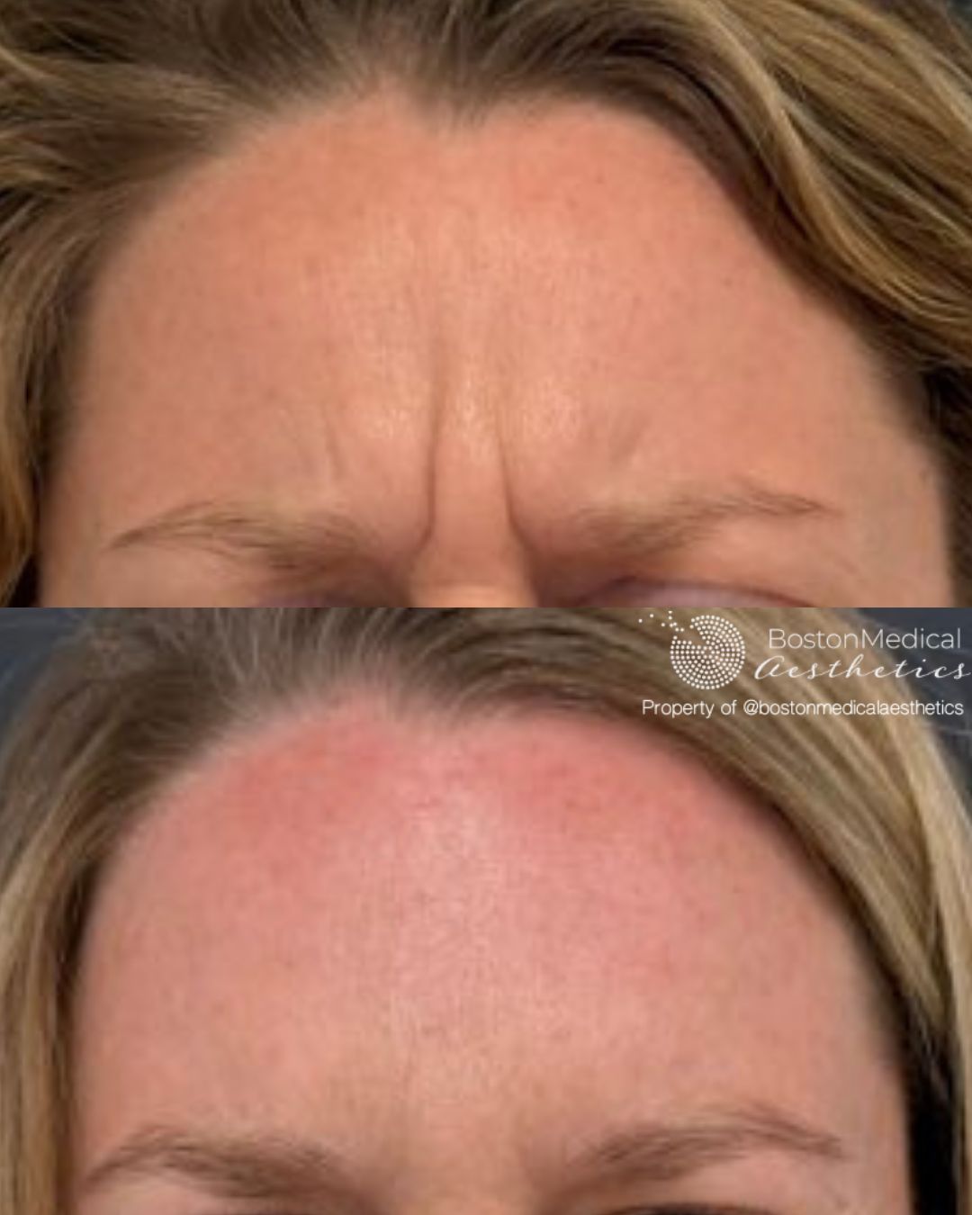 Botox & Dysport Before & After Image
