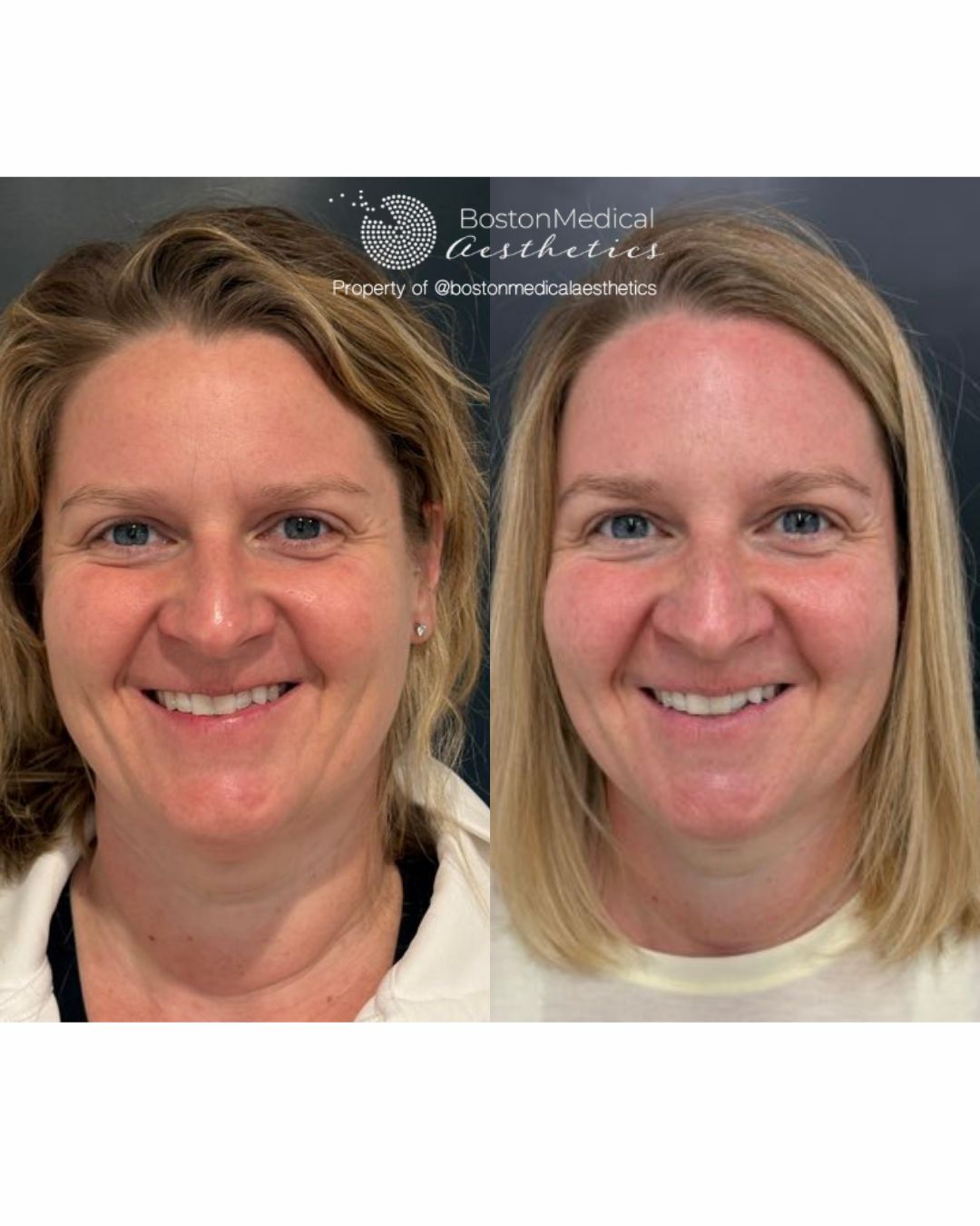 Botox & Dysport Before & After Image