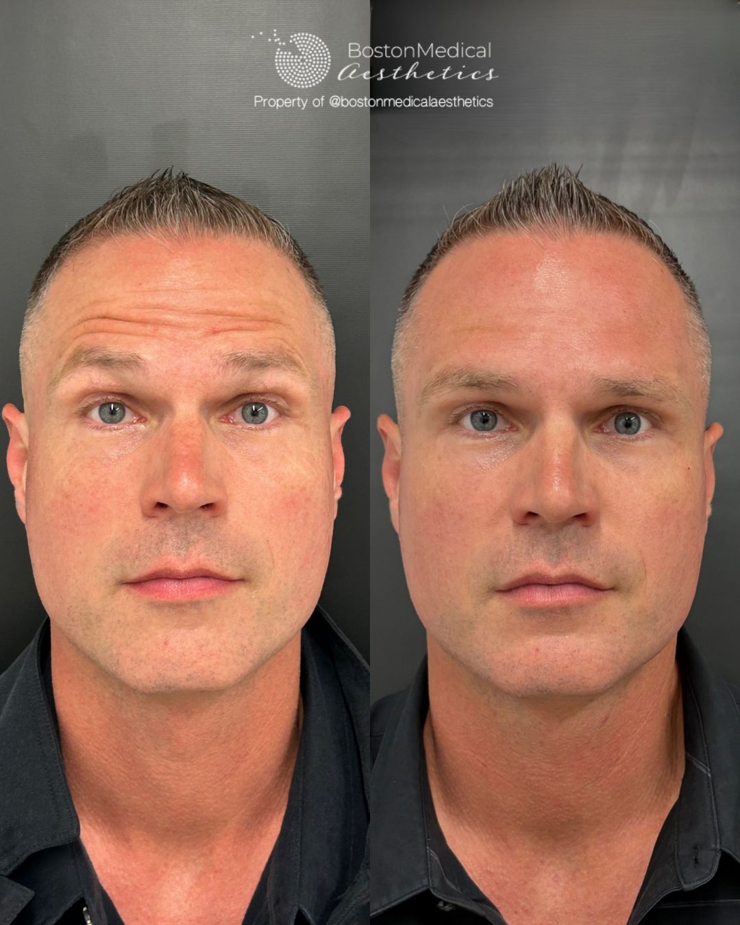 Botox and Dysport Before & After Photo