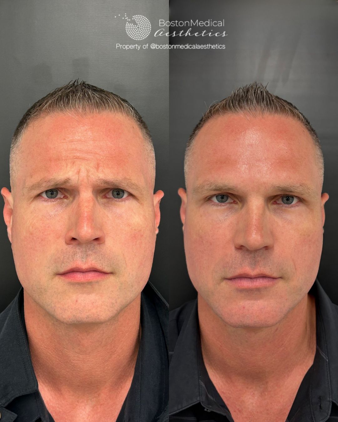 Botox and Dysport Before & After Photo