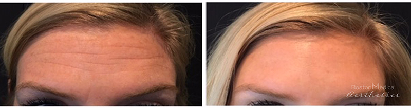 Botox Before & After Photo