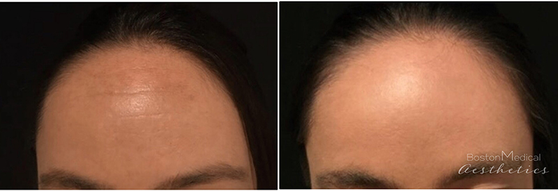 Botox Before & After Photo