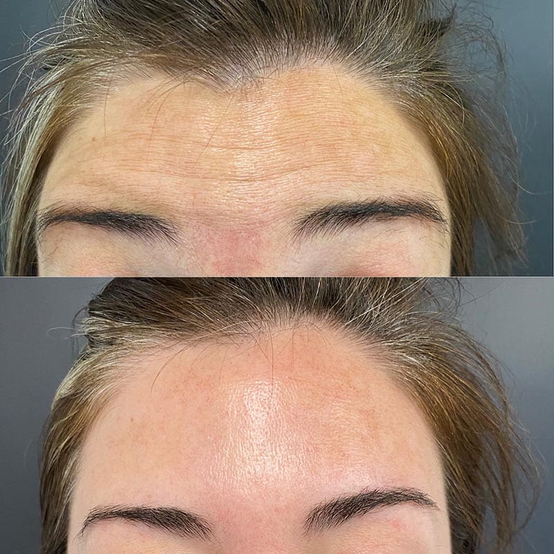 Botox Before & After Photo