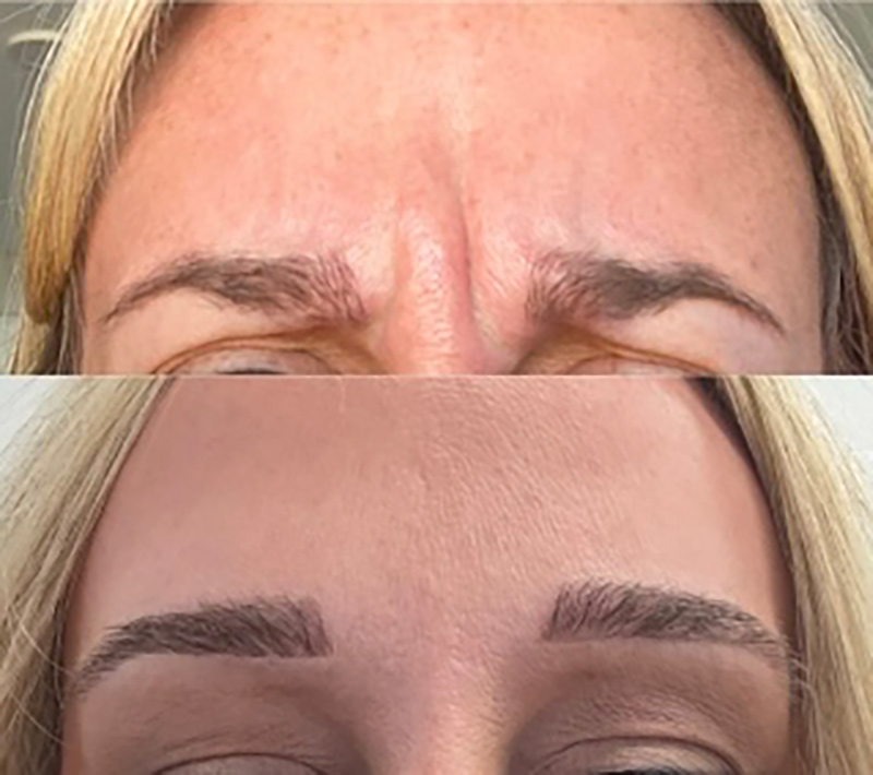 Botox Before & After Photo