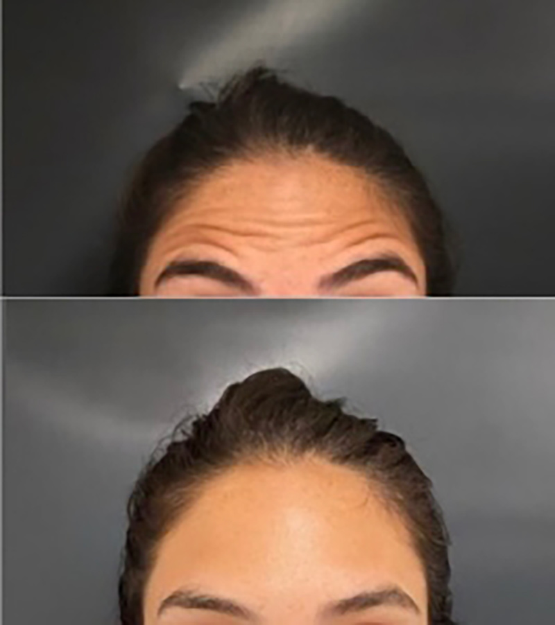 Botox Before & After Photo