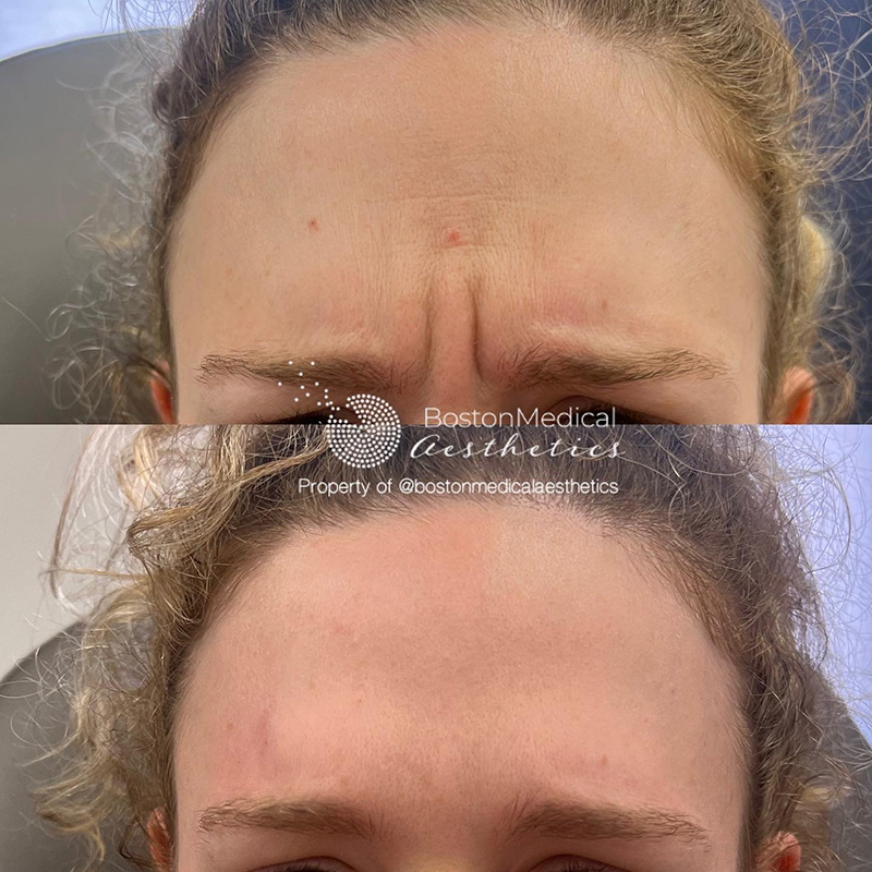 Botox Before & After Photo