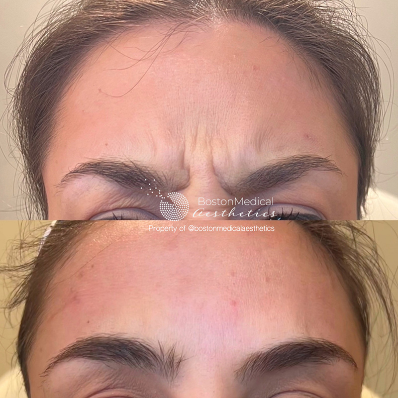 Botox Before & After Photo