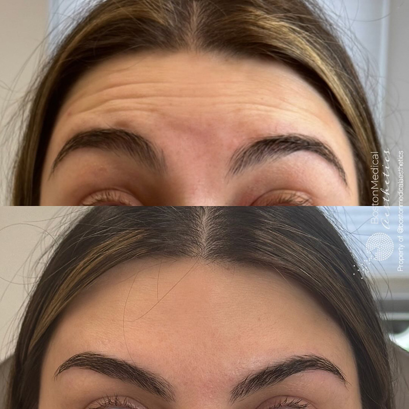 Botox Before & After Photo