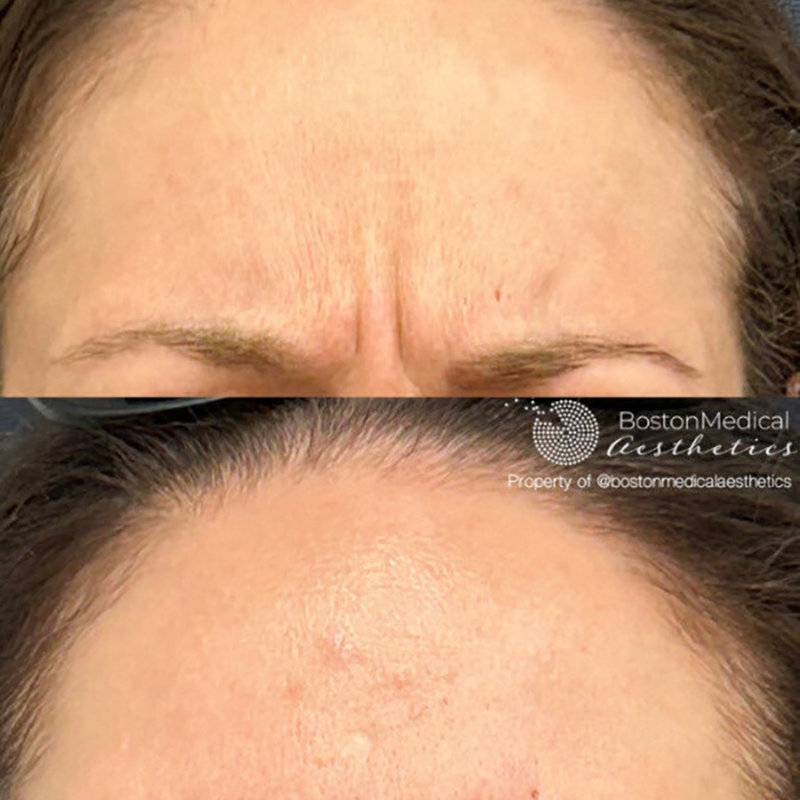Botox and Dysport Before & After Photo