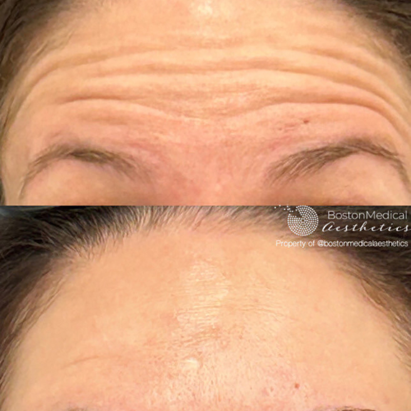 Botox and Dysport Before & After Photo