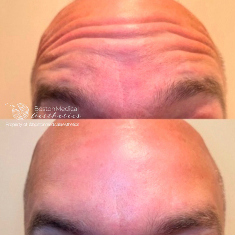 Botox and Dysport Before & After Photo