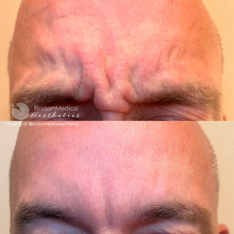 Botox and Dysport Before & After Photo
