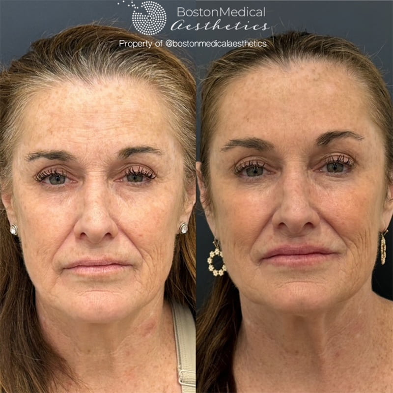 Botox and Dysport Before & After Photo