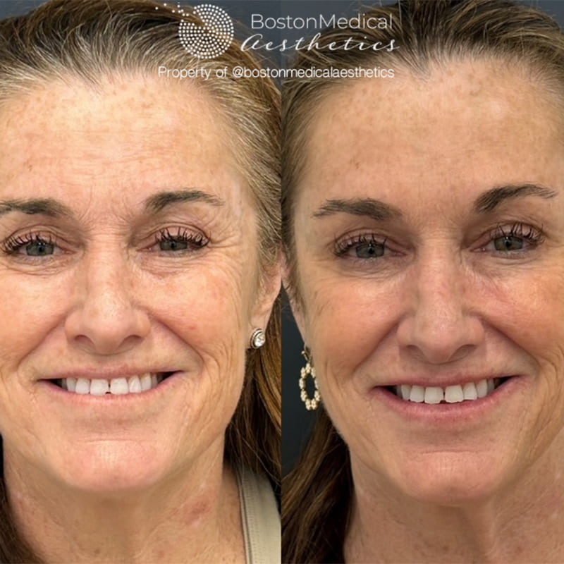Botox and Dysport Before & After Photo