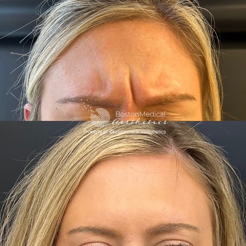 Botox and Dysport Before & After Photo