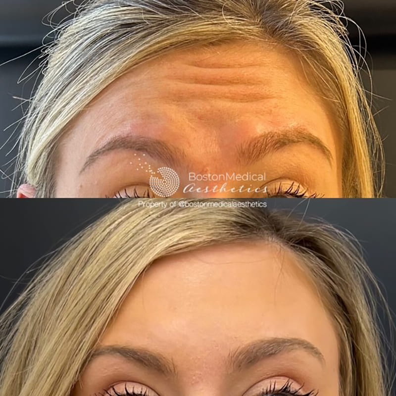 Botox and Dysport Before & After Photo