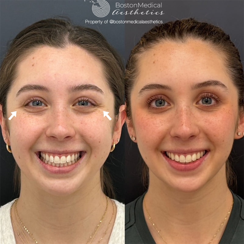 Botox and Dysport Before & After Photo