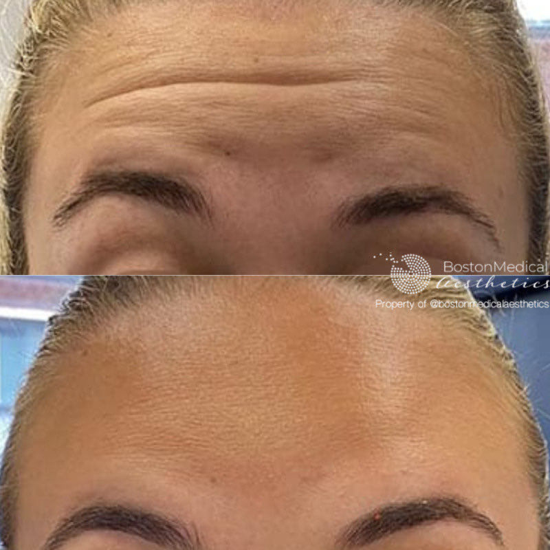 Botox and Dysport Before & After Photo